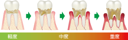 歯周病の進行