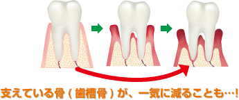 支えている骨(歯槽骨)が、一気に減ることも…!