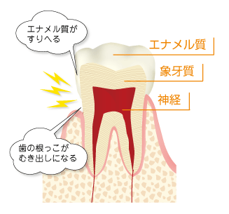 知覚過敏イメージ