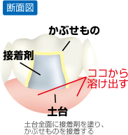 かぶせものの接着