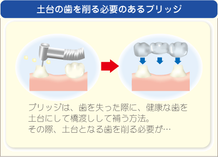 土台を削る必要のあるブリッジ